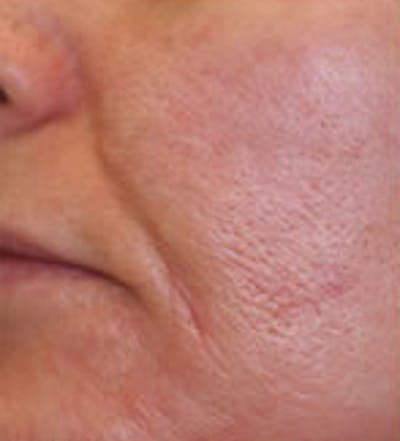 Laser Genesis Before & After Gallery - Patient 331829 - Image 1