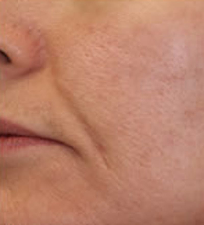 Laser Genesis Before & After Gallery - Patient 331829 - Image 2