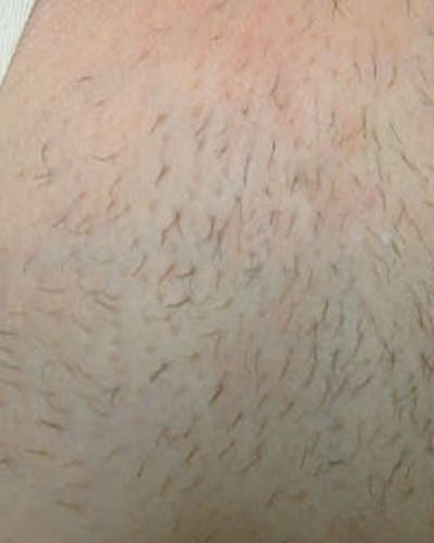 Laser Hair Removal Before & After Gallery - Patient 147929 - Image 1
