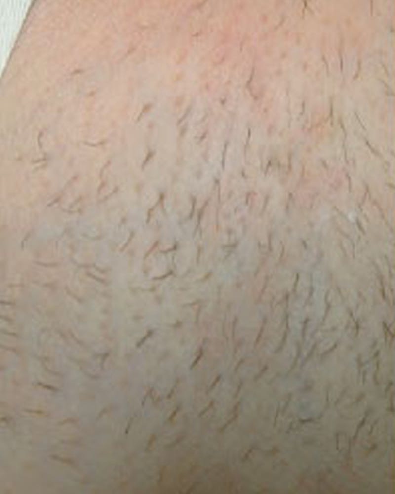 Laser Hair Removal Before & After Gallery - Patient 147929 - Image 1