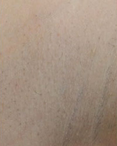 Laser Hair Removal Before & After Gallery - Patient 147929 - Image 2
