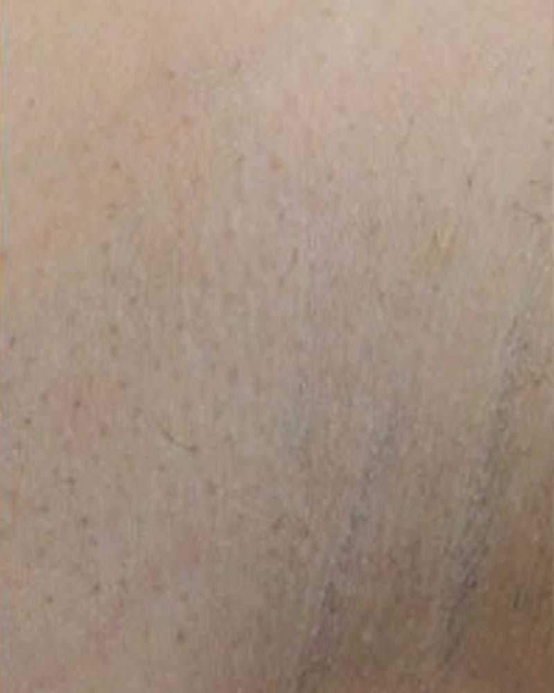 Laser Hair Removal Before & After Gallery - Patient 147929 - Image 2