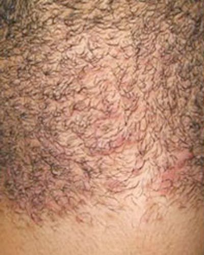 Laser Hair Removal Before & After Gallery - Patient 816239 - Image 1