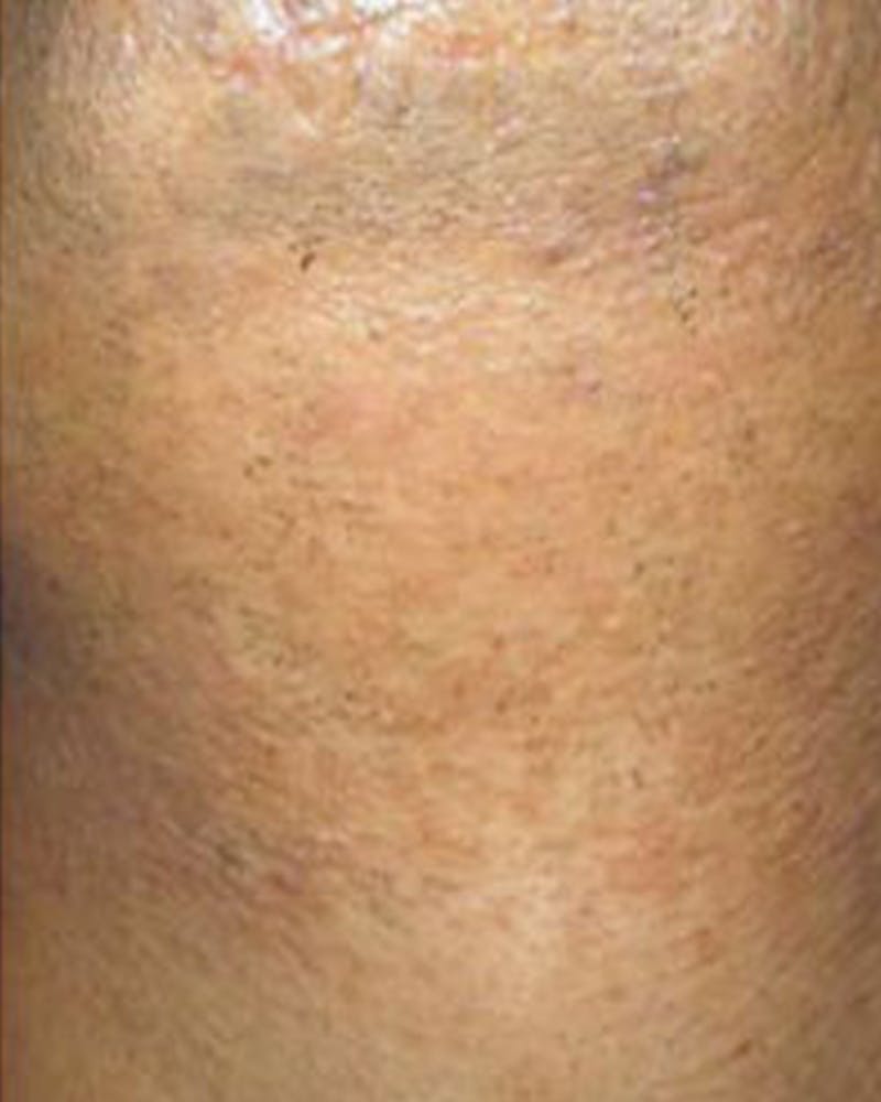 Laser Hair Removal Before & After Gallery - Patient 816239 - Image 2