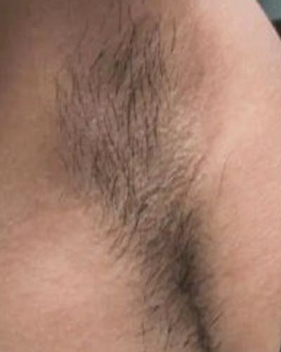 Laser Hair Removal Before & After Gallery - Patient 138602 - Image 1