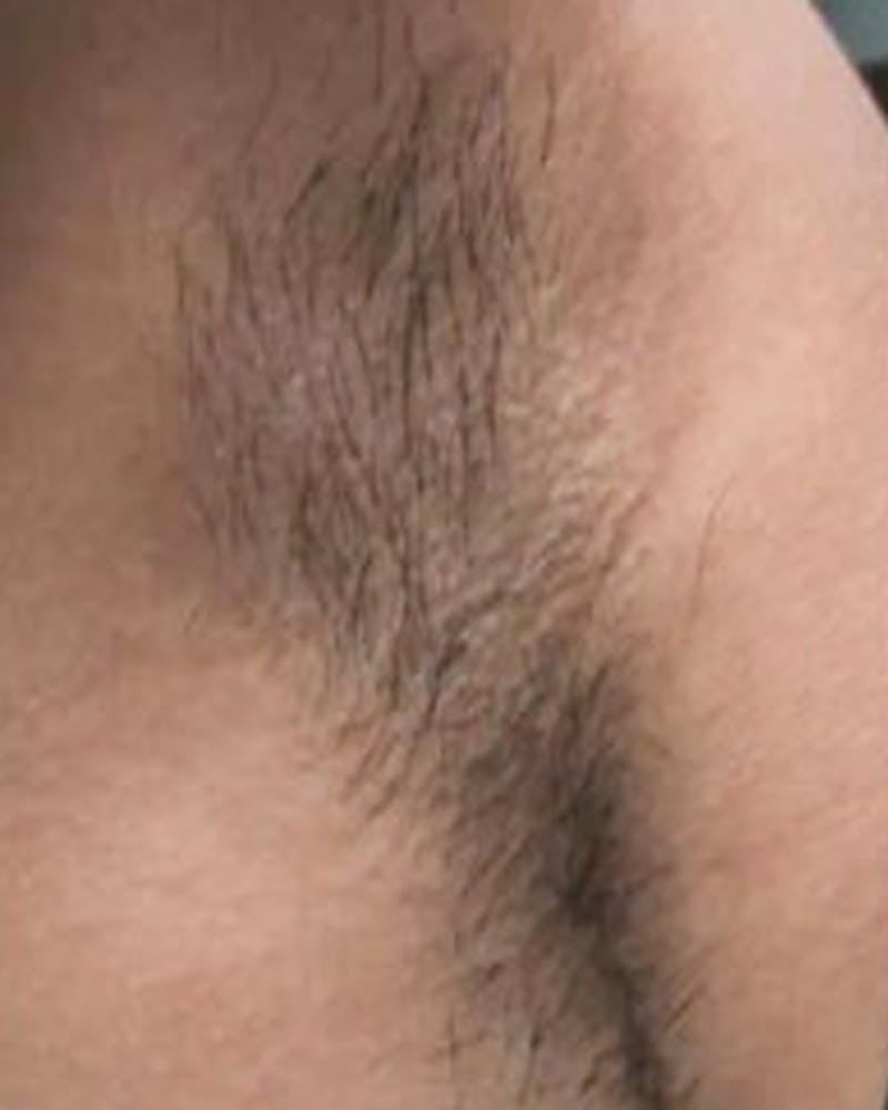 Laser Hair Removal Before & After Gallery - Patient 138602 - Image 1