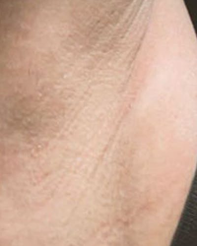 Laser Hair Removal Before & After Gallery - Patient 138602 - Image 2