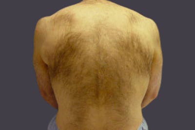 Laser Hair Removal for Men Before & After Gallery - Patient 180648 - Image 1