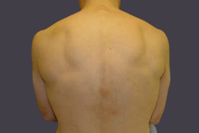 Laser Hair Removal for Men Before & After Gallery - Patient 180648 - Image 2