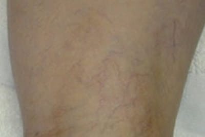 Laser Vein Removal Before & After Gallery - Patient 877706 - Image 1