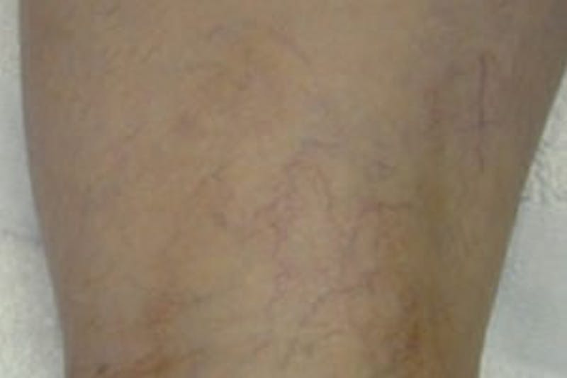 Laser Vein Removal Before & After Gallery - Patient 877706 - Image 1