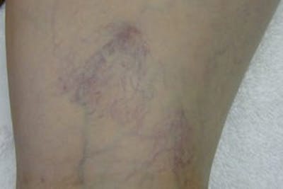 Laser Vein Removal Before & After Gallery - Patient 877706 - Image 2