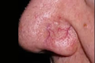Laser Vein Removal Before & After Gallery - Patient 109446 - Image 1