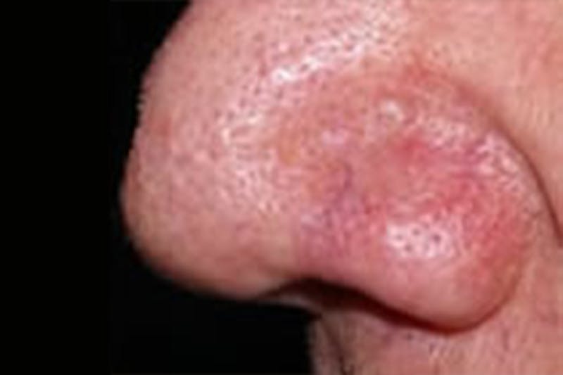 Laser Vein Removal Before & After Gallery - Patient 109446 - Image 2