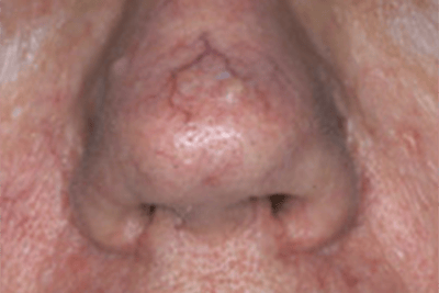 Laser Vein Removal Before & After Gallery - Patient 293339 - Image 1