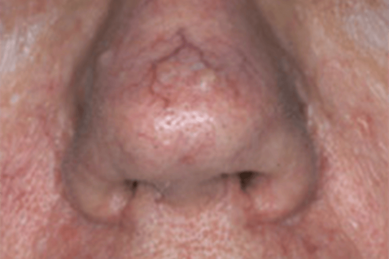 Laser Vein Removal Before & After Gallery - Patient 293339 - Image 1