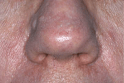 Laser Vein Removal Before & After Gallery - Patient 293339 - Image 2