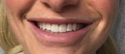 Lip Enhacement Before & After Gallery - Patient 182678 - Image 1
