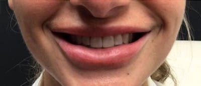 Lip Enhacement Before & After Gallery - Patient 182678 - Image 2