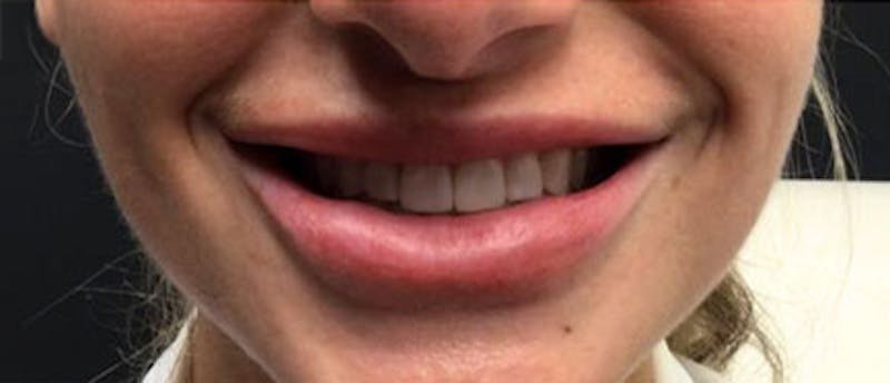 Lip Enhacement Before & After Gallery - Patient 182678 - Image 2