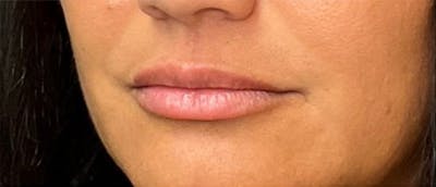 Lip Enhacement Before & After Gallery - Patient 393683 - Image 1