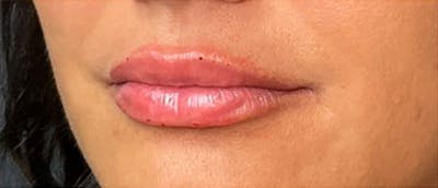 Lip Enhacement Before & After Gallery - Patient 393683 - Image 2