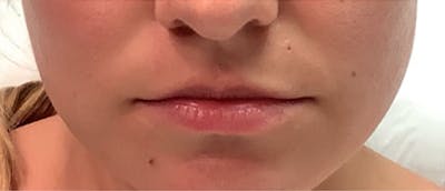 Lip Enhacement Before & After Gallery - Patient 807227 - Image 1