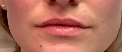 Lip Enhacement Before & After Gallery - Patient 807227 - Image 2
