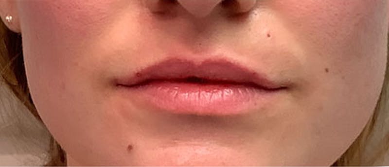 Lip Enhacement Before & After Gallery - Patient 807227 - Image 2