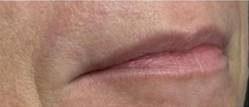 Lip Enhacement Before & After Gallery - Patient 171185 - Image 1