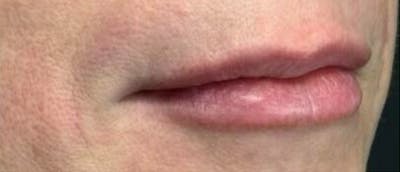 Lip Enhacement Before & After Gallery - Patient 171185 - Image 2