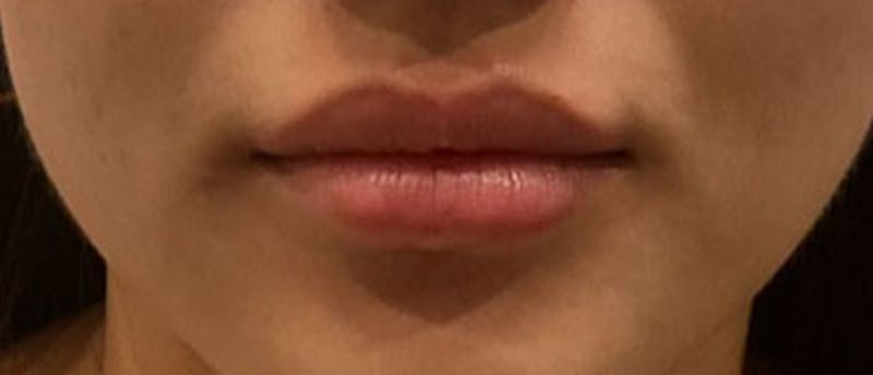 Lip Enhacement Before & After Gallery - Patient 188451 - Image 1