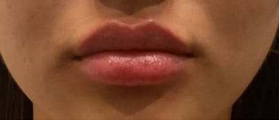 Lip Enhacement Before & After Gallery - Patient 188451 - Image 2