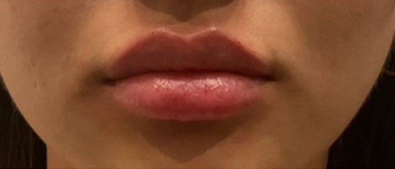 Lip Enhacement Before & After Gallery - Patient 188451 - Image 2