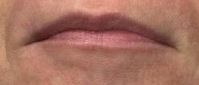 Lip Enhacement Before & After Gallery - Patient 218162 - Image 1