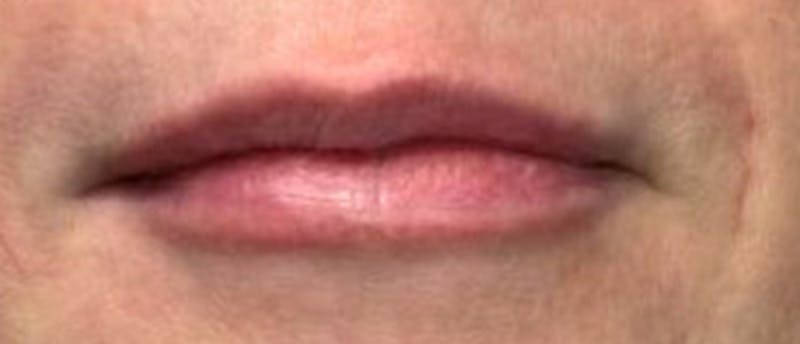 Lip Enhacement Before & After Gallery - Patient 218162 - Image 2