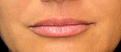 Lip Enhacement Before & After Gallery - Patient 307560 - Image 1