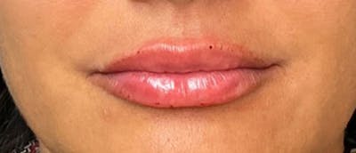 Lip Enhacement Before & After Gallery - Patient 307560 - Image 2