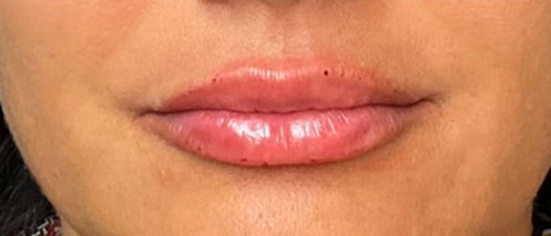 Lip Enhacement Before & After Gallery - Patient 307560 - Image 2