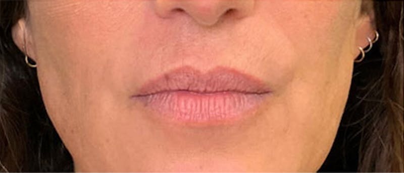 Lip Enhacement Before & After Gallery - Patient 181753 - Image 1