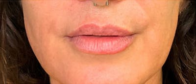 Lip Enhacement Before & After Gallery - Patient 181753 - Image 2