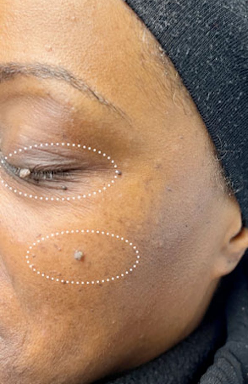Moles, Warts, Skin Tags Before & After Gallery - Patient 324743 - Image 1