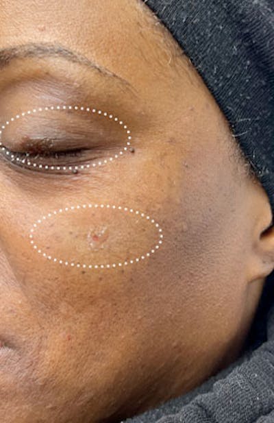 Moles, Warts, Skin Tags Before & After Gallery - Patient 324743 - Image 2