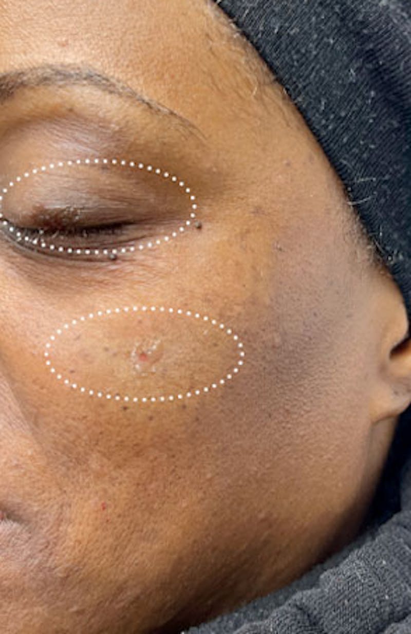 Moles, Warts, Skin Tags Before & After Gallery - Patient 324743 - Image 2