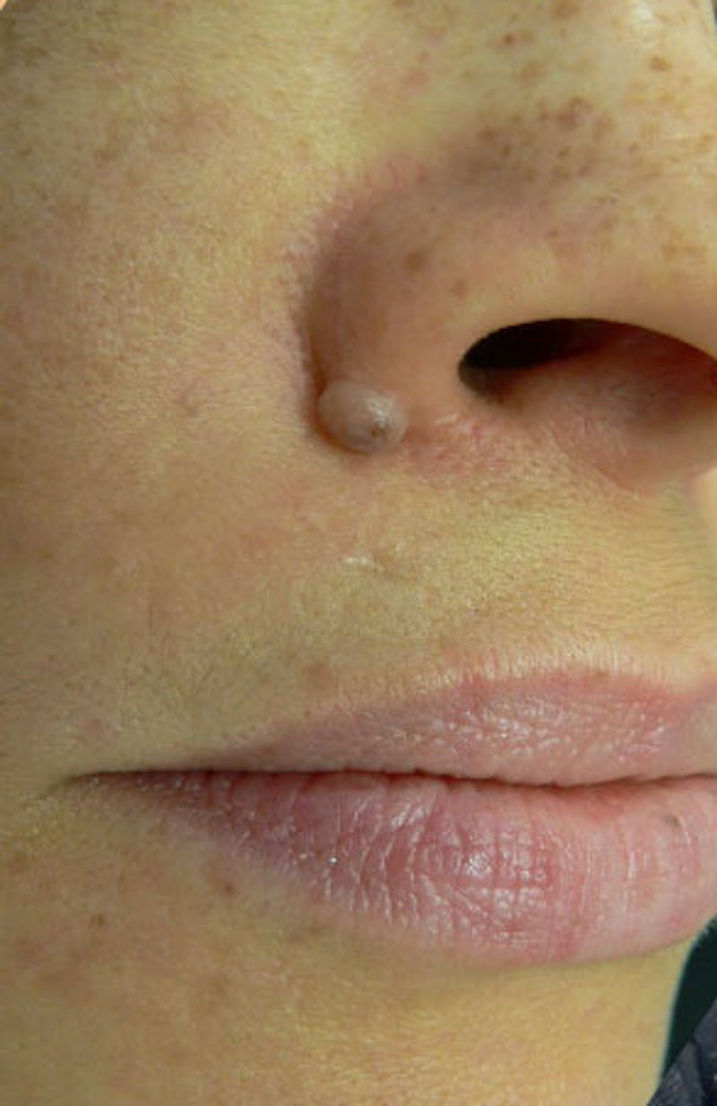 Moles, Warts, Skin Tags Before & After Gallery - Patient 419341 - Image 1