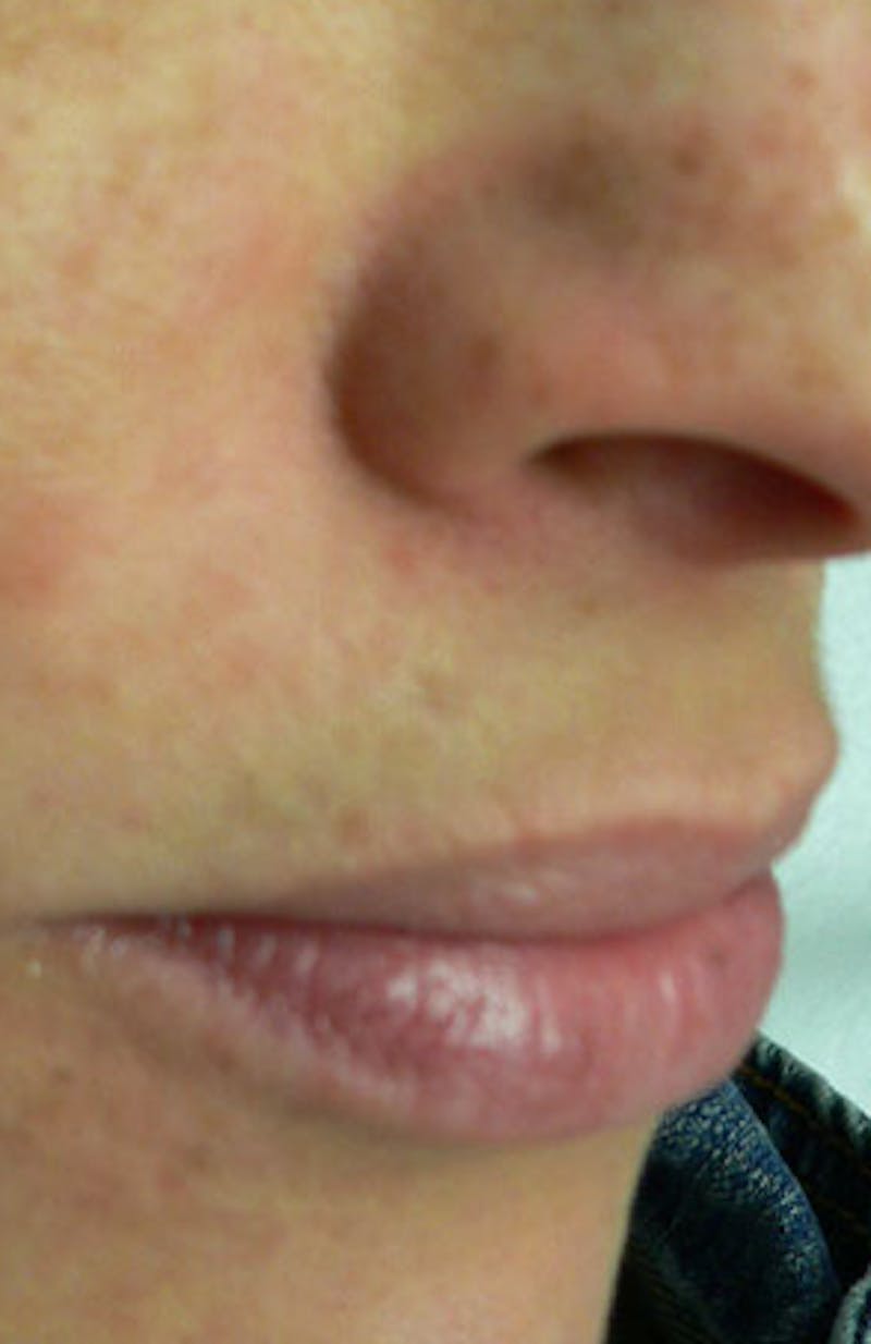 Moles, Warts, Skin Tags Before & After Gallery - Patient 419341 - Image 2