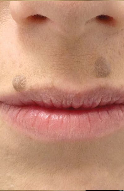 Moles, Warts, Skin Tags Before & After Gallery - Patient 117461 - Image 1