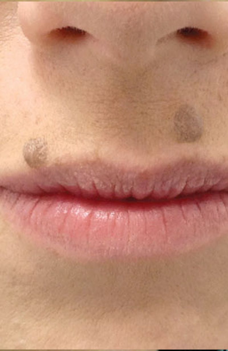 Moles, Warts, Skin Tags Before & After Gallery - Patient 117461 - Image 1