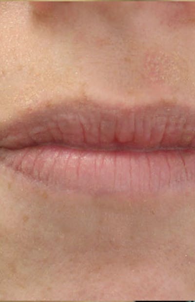 Moles, Warts, Skin Tags Before & After Gallery - Patient 117461 - Image 2