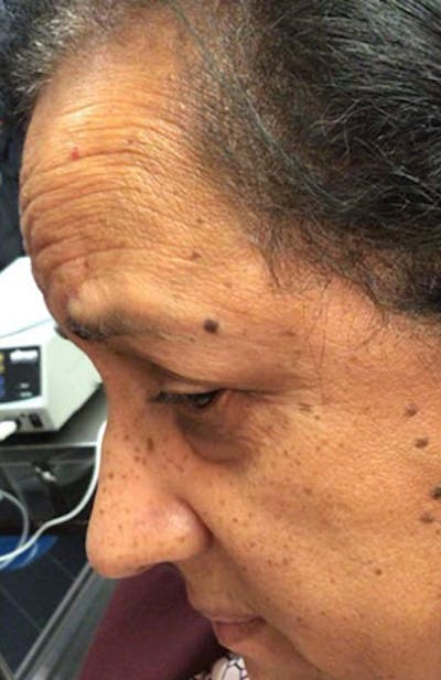Moles, Warts, Skin Tags Before & After Gallery - Patient 373735 - Image 1